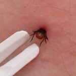 zecca dentro la pelle e pinzette per rimuoverla