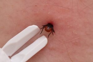 zecca dentro la pelle e pinzette per rimuoverla