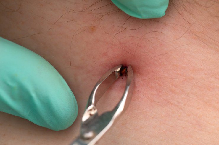 Rimozione zecca con le pinzette primo piano